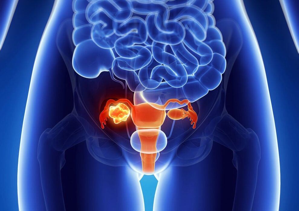 Frau Ovary Pathologie unter Alkoholeinfluss